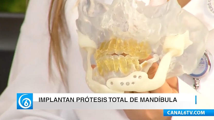 Implantan prótesis total de mandíbula