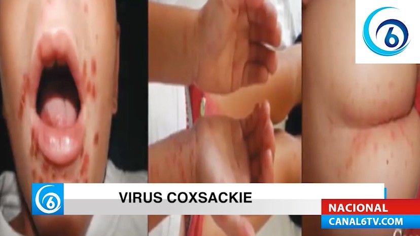 Lo que debes saber del virus de Coxsackie