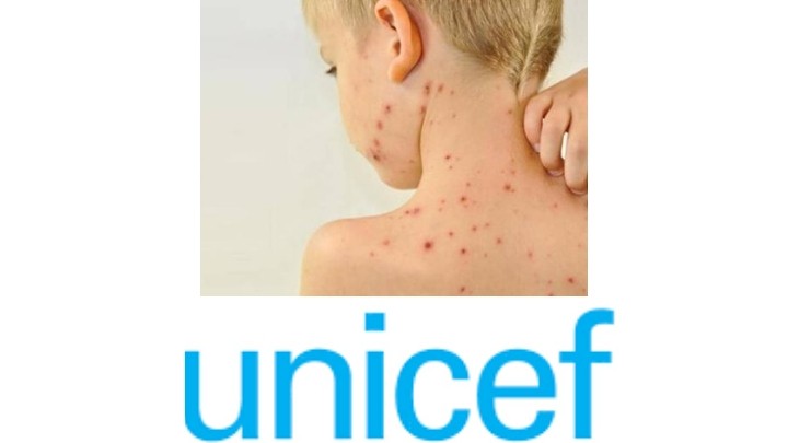 Alerta Unicef por resurgimiento de sarampión en 98 países