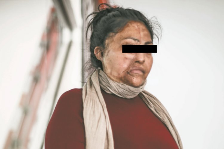 Ataques con ácido a mujeres en México, la punta del iceberg