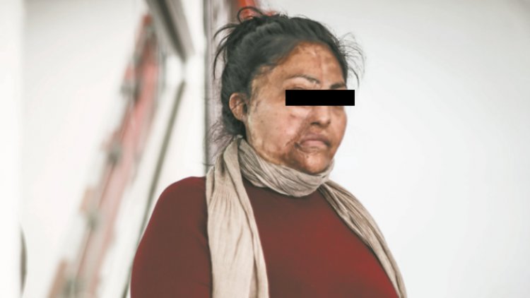 Ataques con ácido a mujeres en México, la punta del iceberg