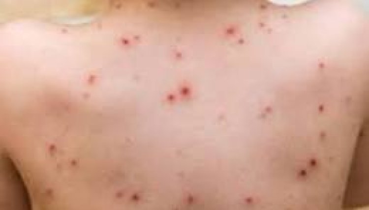 Casos de sarampión en Jalisco han sido en jornaleros migrantes