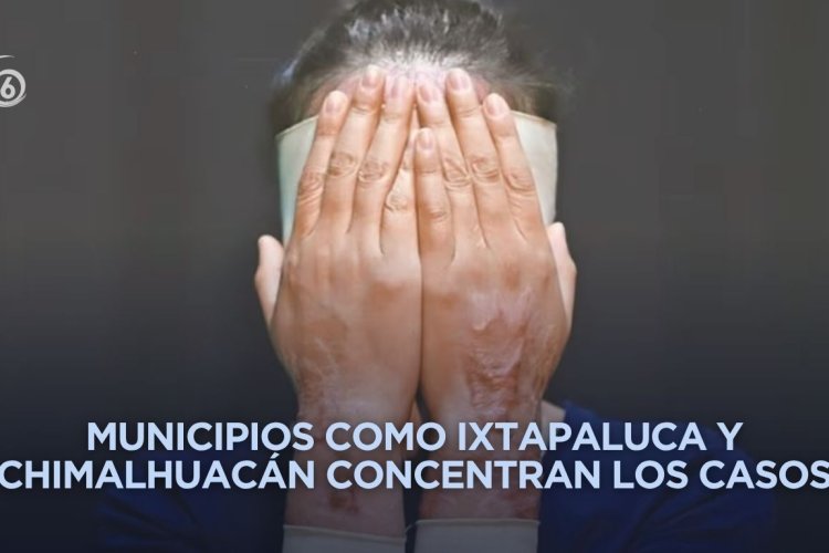 Estado de México, la entidad con más ataques con ácido contra mujeres