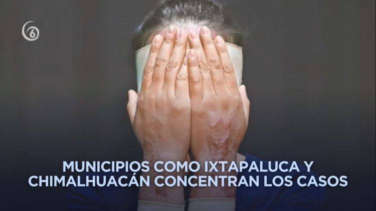 Estado de México, la entidad con más ataques con ácido contra mujeres