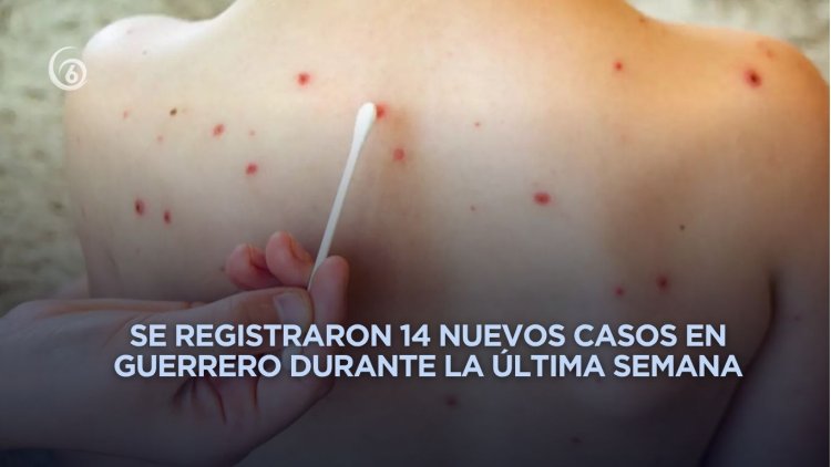 Guerrero se coloca en cuarto lugar nacional con más contagios de sarampión